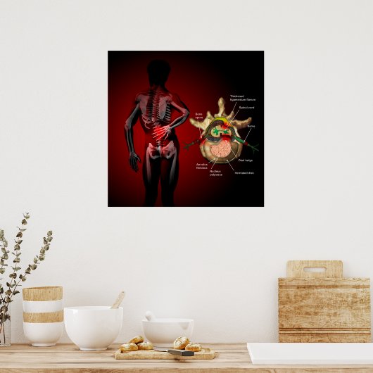 Poster Douleur du dos (Cuisine)