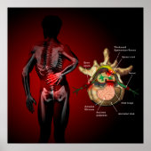 Poster Douleur du dos (Devant)