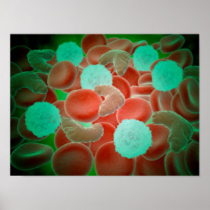 Poster Drépanocytose avec les globules rouges