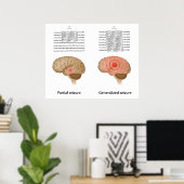 Poster EEG dans l'épilepsie partielle et généralisée Post (Bureau à domicile)