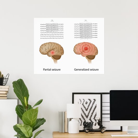 Poster EEG dans l'épilepsie partielle et généralisée Post (Bureau à domicile)