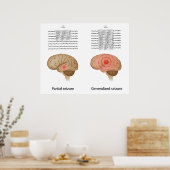 Poster EEG dans l'épilepsie partielle et généralisée Post (Cuisine)