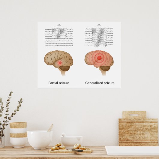 Poster EEG dans l'épilepsie partielle et généralisée Post (Cuisine)