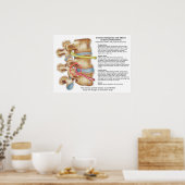 Poster Effets de la subbluxation de la colonne vertébrale (Cuisine)