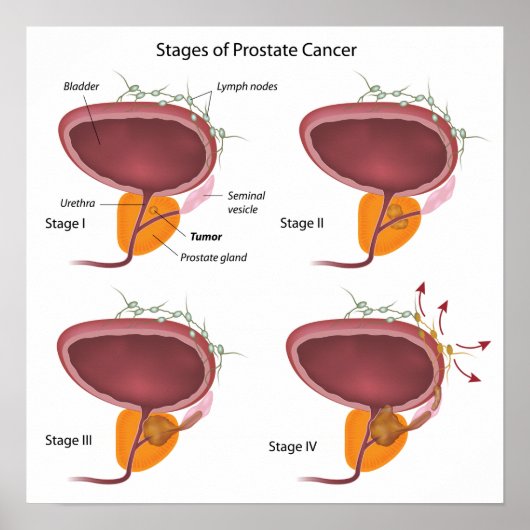 Poster Étapes du cancer de la prostate (Devant)