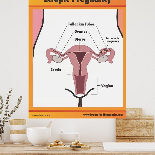 Poster Grossesse ectopique (Cuisine)