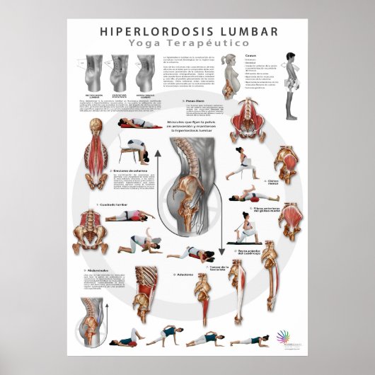Poster Hiperlordosis - définition, causes et traitement (Devant)