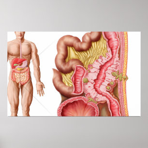 Poster Illustration De La Diverticulose Dans Le Colon