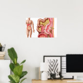 Poster Illustration De La Diverticulose Dans Le Colon (Bureau à domicile)