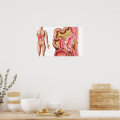 Poster Illustration De La Diverticulose Dans Le Colon (Cuisine)