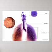 Poster Illustration d'une crise d'asthme causée par le po (Devant)