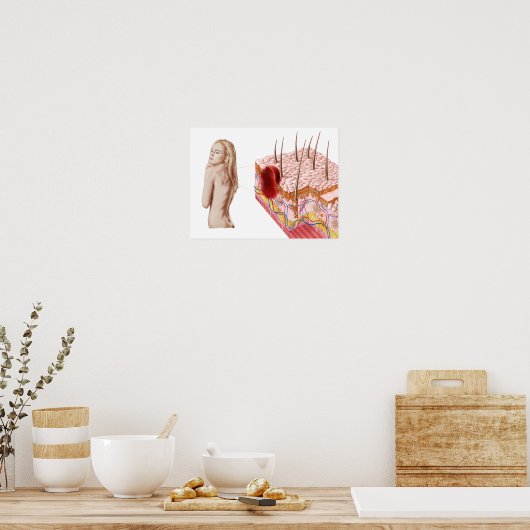 Poster Illustration D'Une Croissance Atypique Sur La Peau (Cuisine)