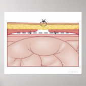 Poster Illustration d'une hernie (Devant)