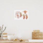 Poster Illustration Médicale D'Un Cyst Pilonidal (Cuisine)