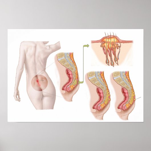 Poster Illustration Médicale D'Un Cyst Pilonidal (Devant)