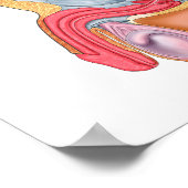 Poster Illustration Médicale D'Une Fistule Rectouréthrale (Coin)