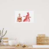 Poster Illustration Médicale D'Une Hernie Hiatal Dans (Cuisine)