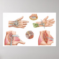 Illustration Médicale montrant le tunnel carpal