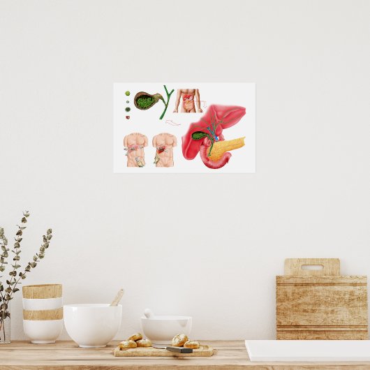 Poster Illustration montrant la cholécystectomie (Cuisine)