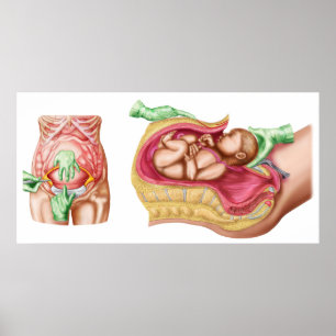 Poster Illustration montrant la livraison césarienne du