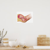Poster Illustration Montrant La Livraison Du Foetus 2 (Cuisine)