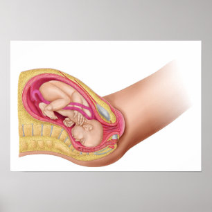 Poster Illustration Montrant La Livraison Du Foetus 2