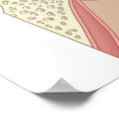 Poster Implants cochléaires (Coin)