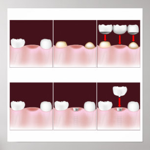Poster Implants dentaires vs pont fixe, ajoutez votre tex