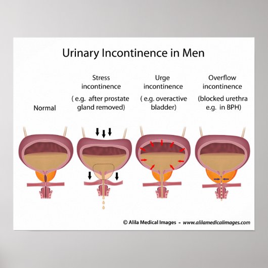 Poster Incontinence urinaire masculine (Devant)