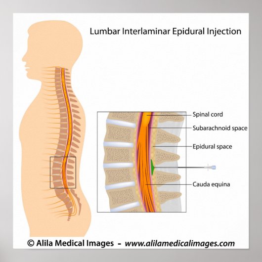 Poster Injection épidurale Lumbar, diagramme étiqueté. (Devant)