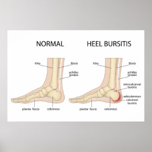 Poster La difformité de Haglund