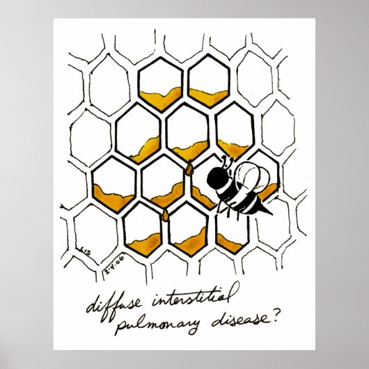 Poster Maladie pulmonaire interstitielle diffuse (Devant)