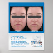 Poster Marini Peel Clarify Résultats 18x24" (Devant)