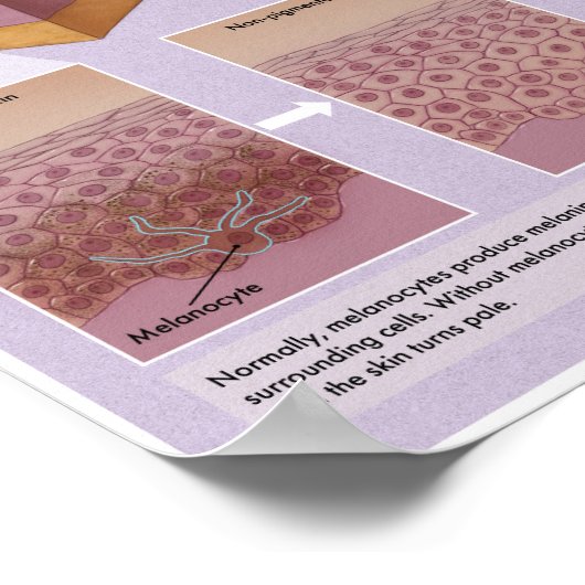Poster Médicale Melalogo Vitiligo (Coin)
