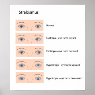 Poster met strabismus-oogdefect