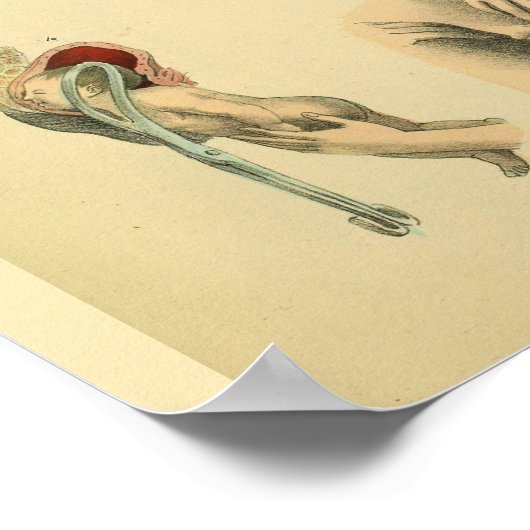 Poster Muscles de cuisse Forceps de naissance Anatomie Ar (Coin)