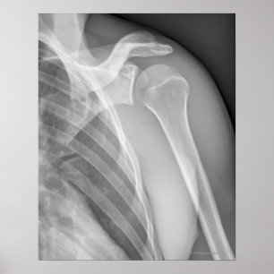 Poster Normal shoulder. X-ray of the healthy left