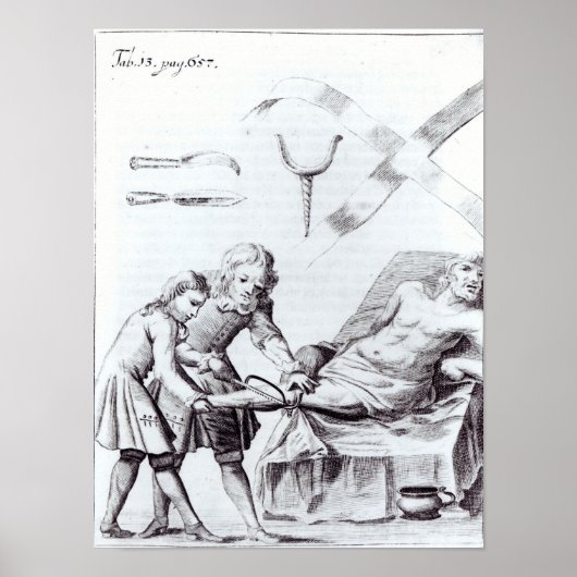 Poster Opération chirurgicale pour amputer une jambe (Devant)