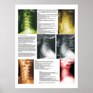 Poster Phases Espagnoles Cervical Spinal Degeneration Pos