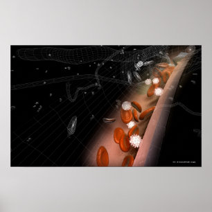 Poster Plaque dans les artères