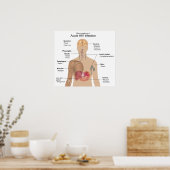 Poster Principaux symptômes de l'infection aiguë par le V (Cuisine)