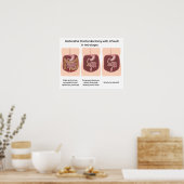 Poster Proctocolectomie réparatrice avec j-pouch 2 étapes (Cuisine)