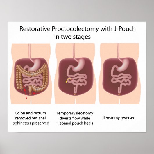 Poster Proctocolectomie réparatrice avec j-pouch 2 étapes (Devant)
