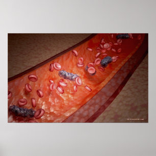 Poster Rendu microscopique d'une infection sanguine
