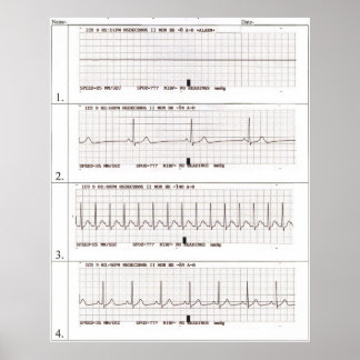 Poster rythmes ekg