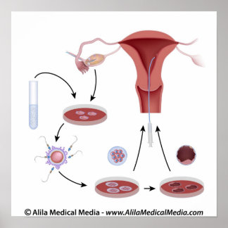 Poster Schéma sans étiquette de la procédure IVF.