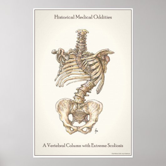 Poster Scoliose Spine (Devant)