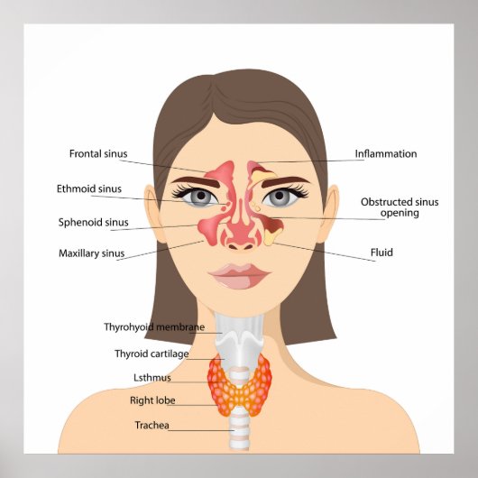 Poster Sinusitis (Devant)