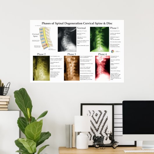 Poster Spinal Degeneration Cervical Spine Chiropractic (Bureau à domicile)