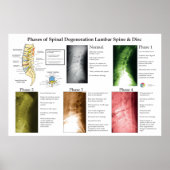 Poster Spinal Degeneration Lumbar Spine Chiropractic (Devant)
